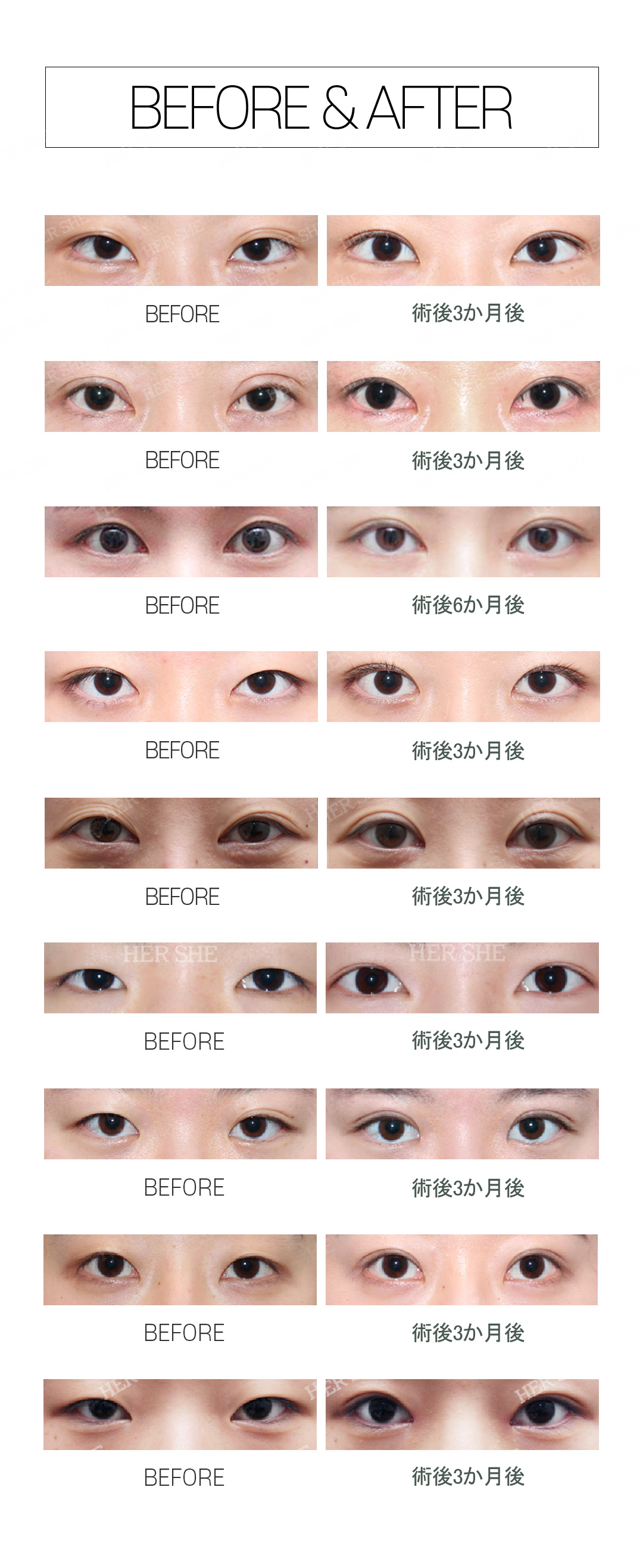 Phẫu thuật lại mí đôi bấm mí | Tư vấn cá nhân bởi Viện trưởng Kim Ju-bong bác sĩ chuyên về mắt | HERSHE Thẩm mỹ Cheongdam