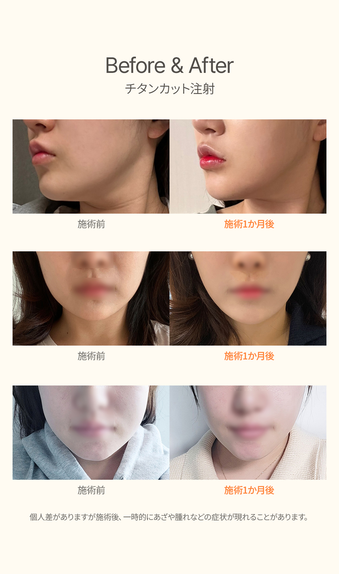 Tiêm Titanium Cut | Thủ thuật đồng thời nâng x tan mỡ nhằm V-line | Uline Clinic