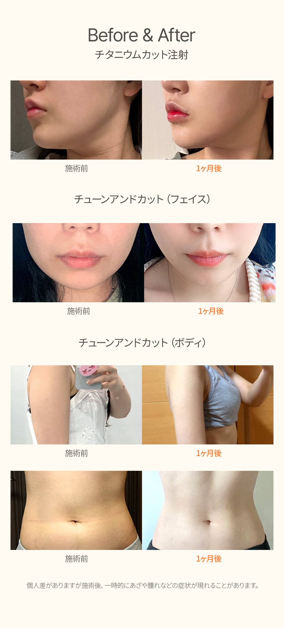 Titanium Lift, Tune Face, Tiêm tan mỡ Hàn Quốc | Chăm sóc nâng kết hợp sóng cao tần x siêu âm | Uline Clinic