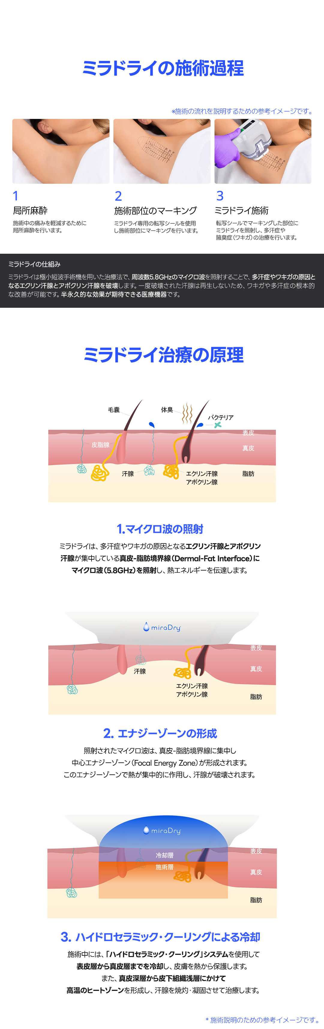 Hướng đến cải thiện đa hãn chứng・hôi nách bằng MiraDry Fresh LEVEL5｜HERSHE Phẫu thuật Thẩm mỹ Cheongdam Seoul