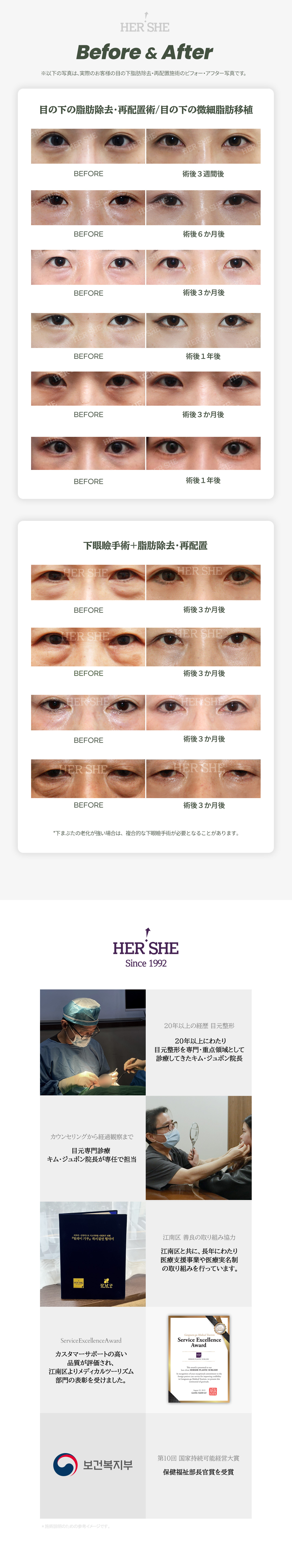 Thẩm mỹ viện HERSHE | Loại bỏ và tái phân bổ mỡ dưới mắt để cải thiện quầng thâm và chảy xệ | Seoul Cheongdam