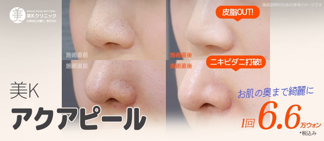 Chăm sóc lỗ chân lông Aqua Peel | Loại bỏ tế bào chết, bã nhờn, demodex theo 3 bước | Phòng khám MiK (kết nối trực tiếp ga Gangnam)