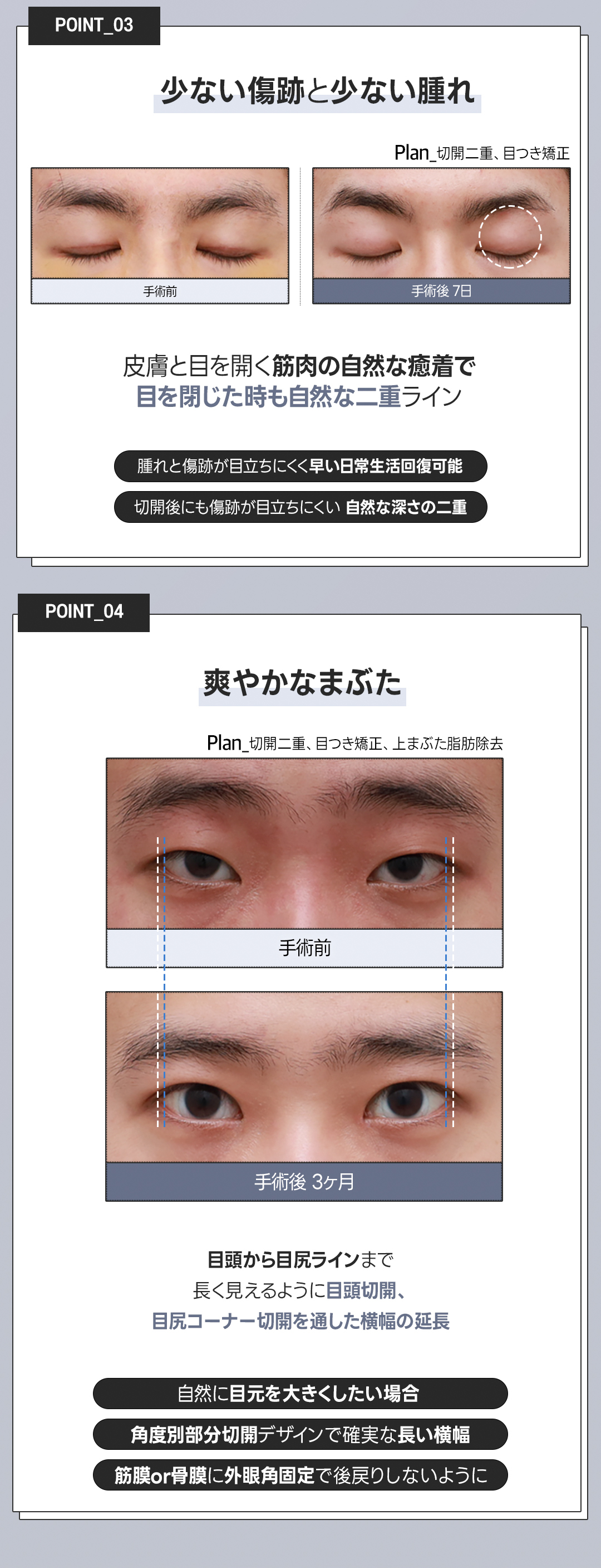 Phẫu thuật mí đôi nam Hàn Quốc | Hướng tới ấn tượng tươi mát với đôi mắt tự nhiên | Phòng khám Weavers Thẩm mỹ
