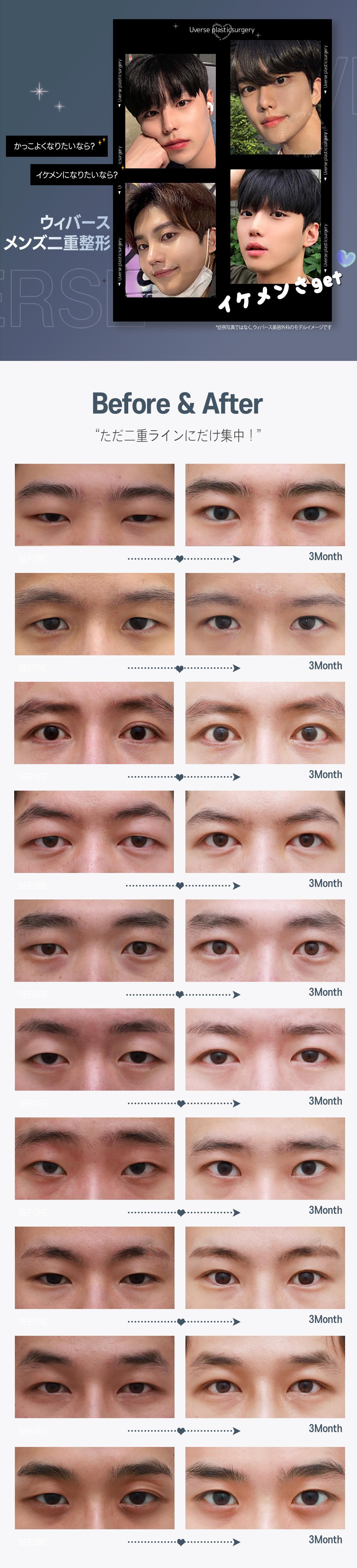 Phẫu thuật mí đôi nam Hàn Quốc | Hướng tới ấn tượng tươi mát với đôi mắt tự nhiên | Phòng khám Weavers Thẩm mỹ