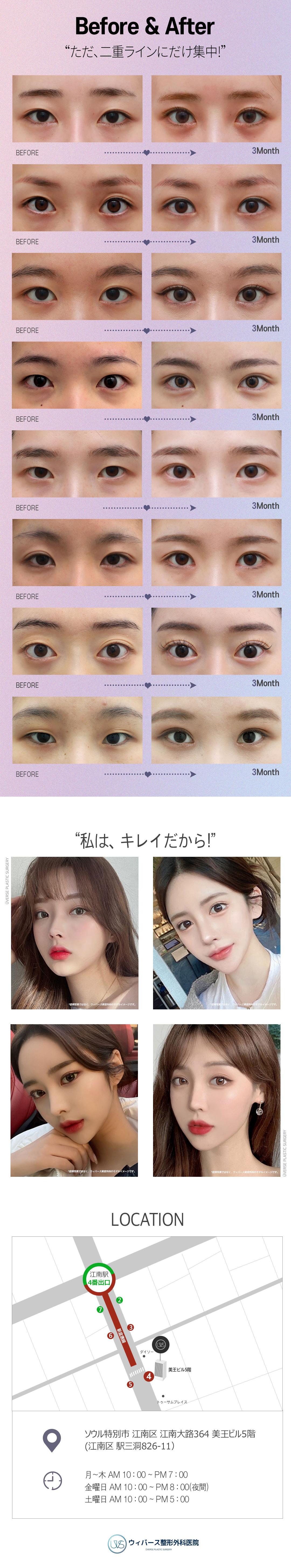 Weavers Thẩm mỹ Seoul Gangnam｜Hướng đến đường viền khó tuột với chỉnh hình mí đôi bám dính tự nhiên｜Phương pháp cố định chân bì