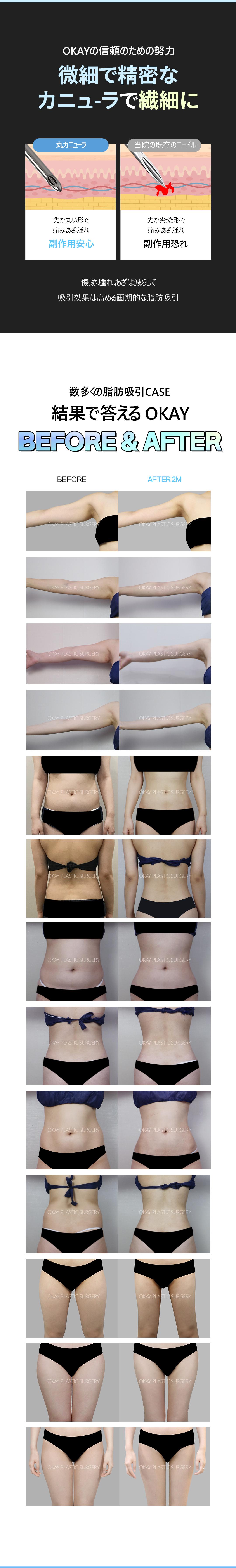 【Hút mỡ theo vùng】Hướng đến body line lý tưởng với dung lượng lớn | Seoul Cheongdam stn. - OK Clinic