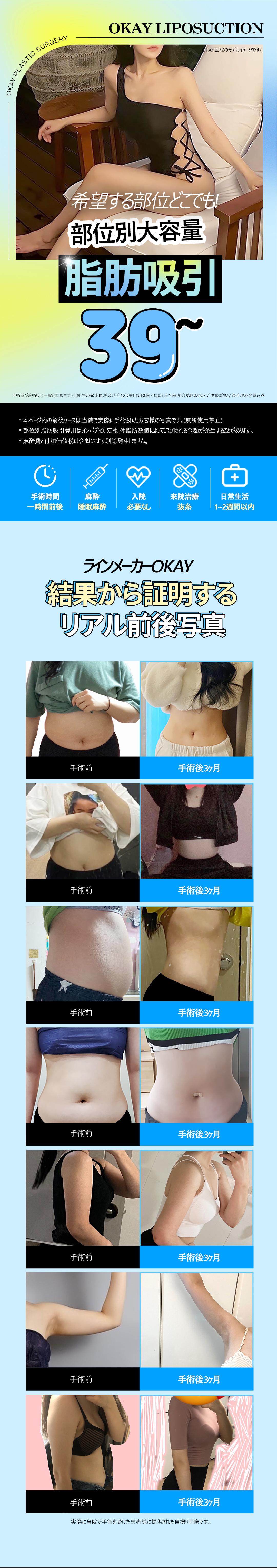 【Hút mỡ theo vùng】Hướng đến body line lý tưởng với dung lượng lớn | Seoul Cheongdam stn. - OK Clinic