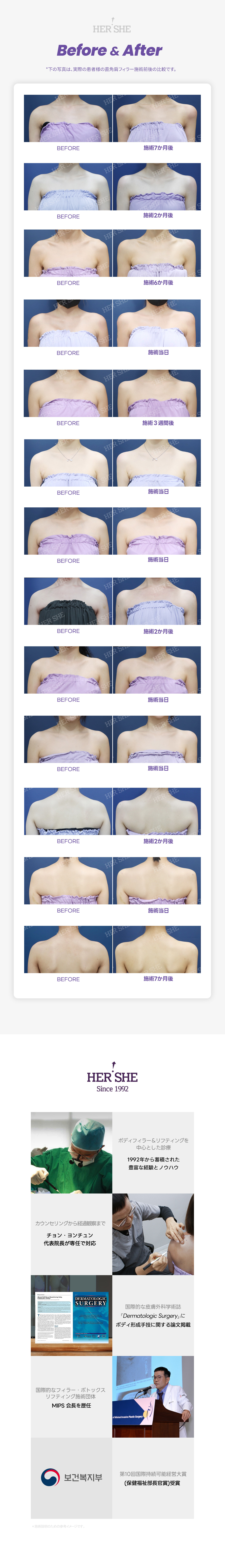 Filler vai vuông góc, Botox vai | Cải thiện vai xuôi cho đường nét body đẹp | Seoul HERSHE Thẩm mỹ Phẫu thuật Tạo hình