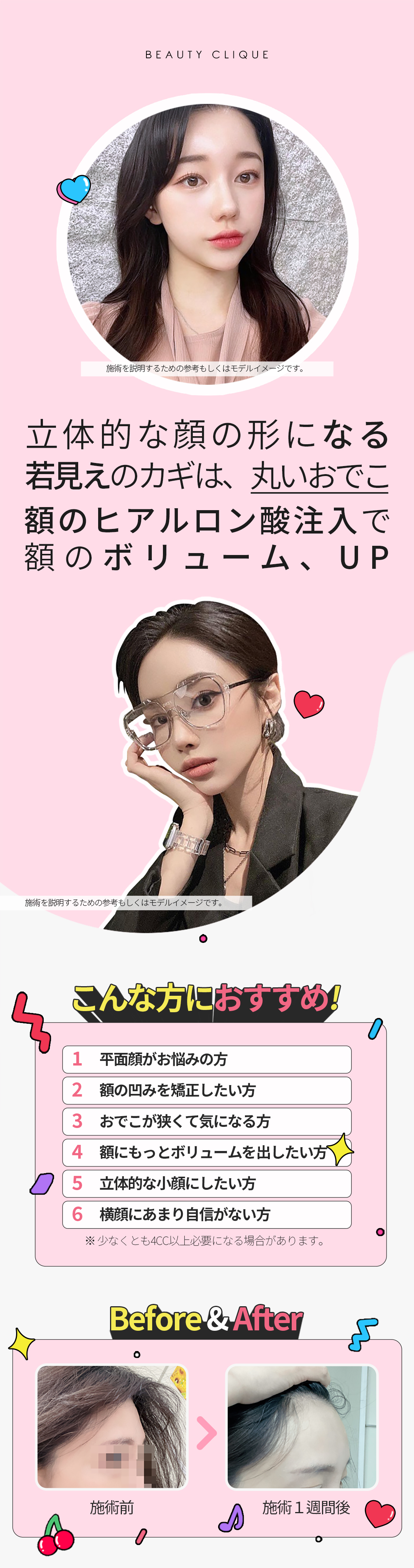 Tiêm Hyaluronic Acid trán hướng đến trán tròn lập thể｜Phẫu thuật Thẩm mỹ Pixel Lab｜Ga Gangnam Seoul