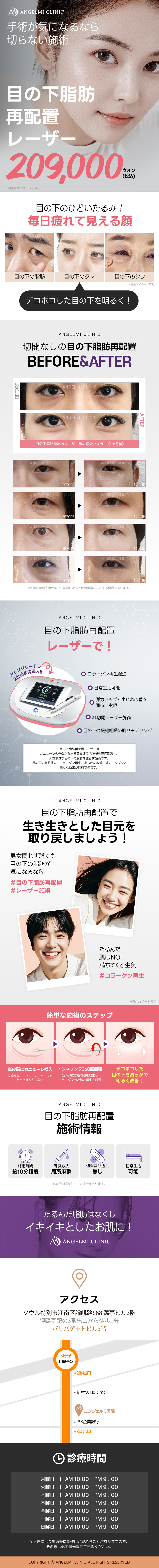 【Apgujeong Hàn Quốc】Laser tái định vị mỡ bọng mắt | Cải thiện chảy xệ & quầng thâm vùng mắt chỉ 10 phút không cần rạch | Phòng khám Angel Mi