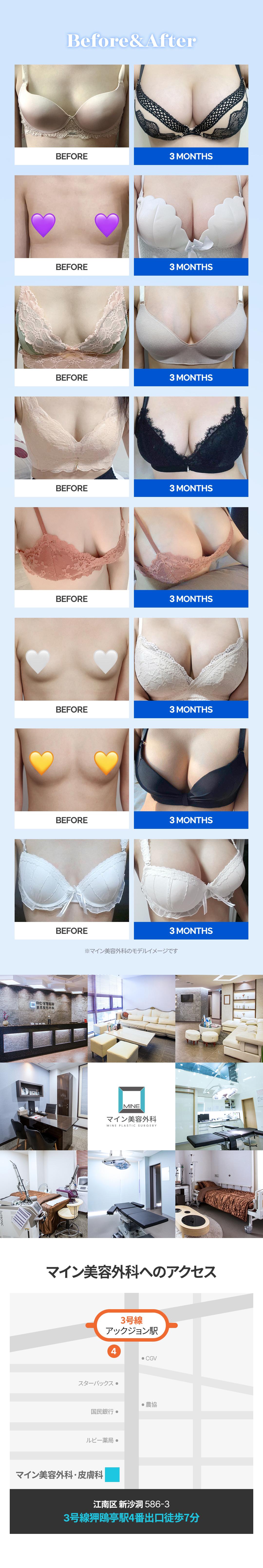 Phẫu thuật nâng ngực Mentor Extra | Hướng tới kết quả tự nhiên với kỹ thuật nội soi Dry Pocket | Seoul Apgujeong Mine Plastic Surgery