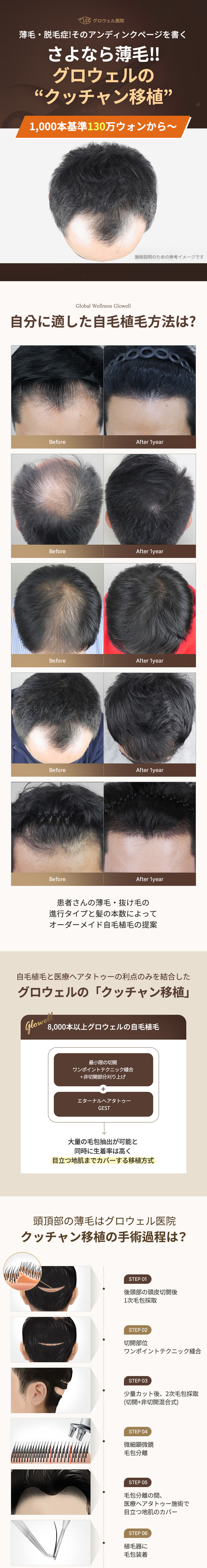 Cấy tóc tự thân Kkutchan Hàn Quốc | Hướng đến cải thiện tóc thưa với rạch + không rạch + xăm tóc y tế | Growwell Phòng khám Yeouido