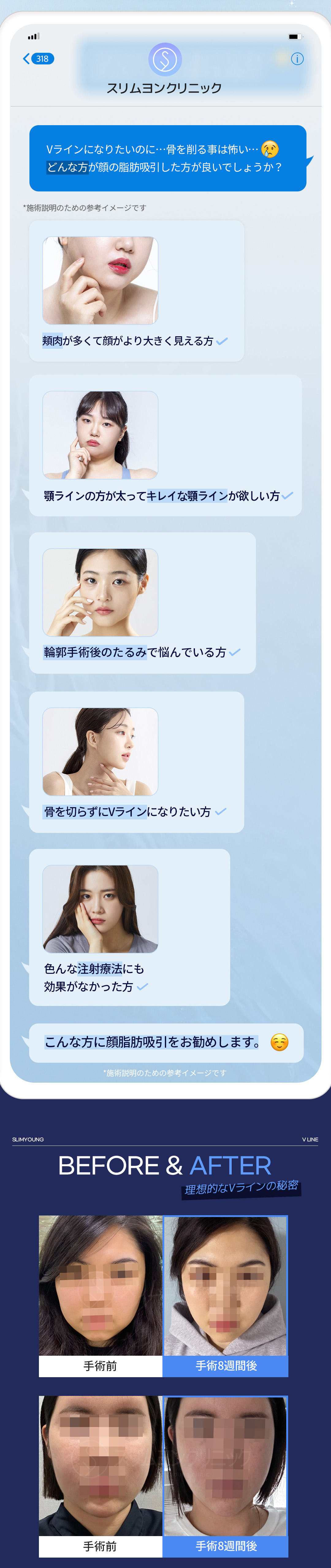 【Hàn Quốc Myeongdong】Hút mỡ mặt hướng đến V-line tự nhiên | Cải thiện đường viền không cần gọt xương | Slim Young Clinic