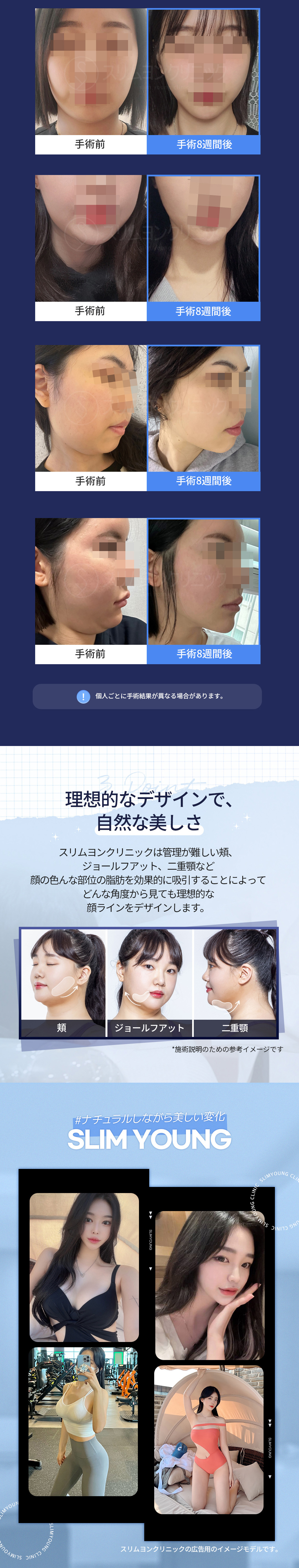 【Hàn Quốc Myeongdong】Hút mỡ mặt hướng đến V-line tự nhiên | Cải thiện đường viền không cần gọt xương | Slim Young Clinic