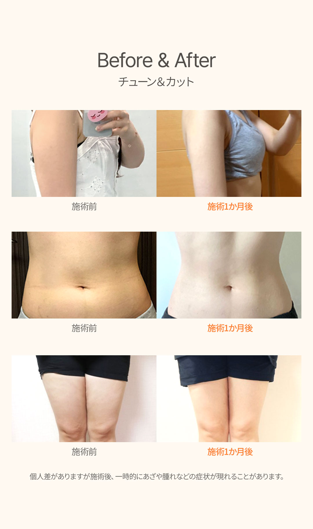 Tiêm Tune & Cut | Giảm béo y tế phá hủy tế bào mỡ + cải thiện đường cong cơ thể | U-Line Clinic Gangnam Seoul