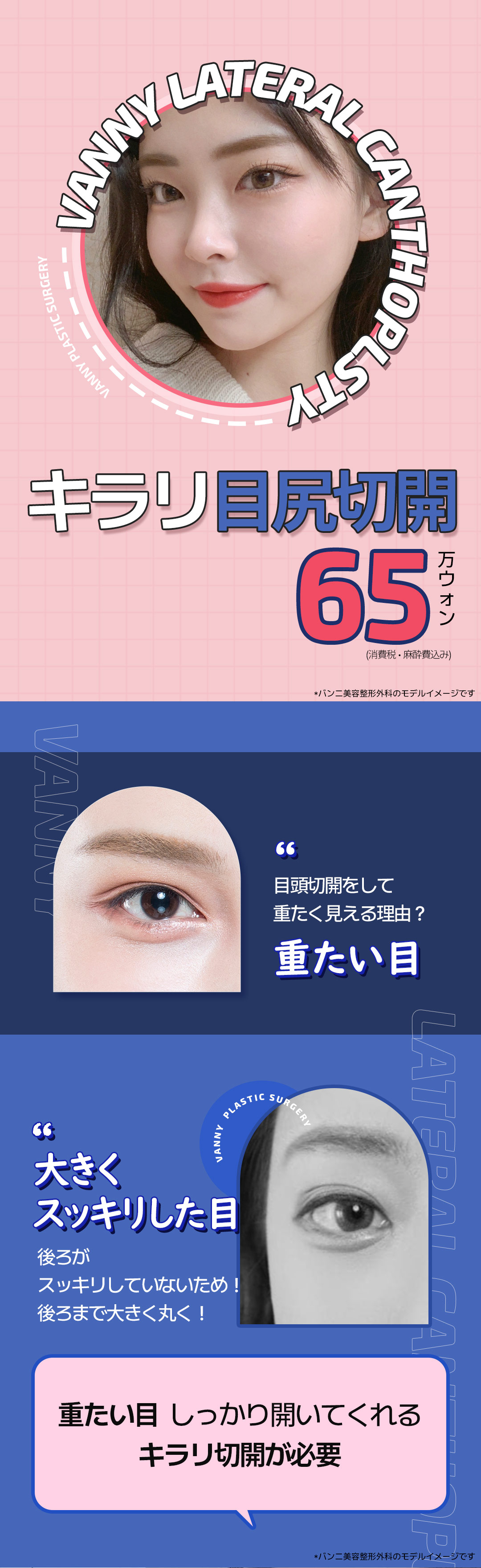 Cắt đuôi mắt Kirari | Mở rộng chiều ngang・chiều dọc mắt tự nhiên | Banni Thẩm mỹ cách ga Gangnam 1 phút đi bộ