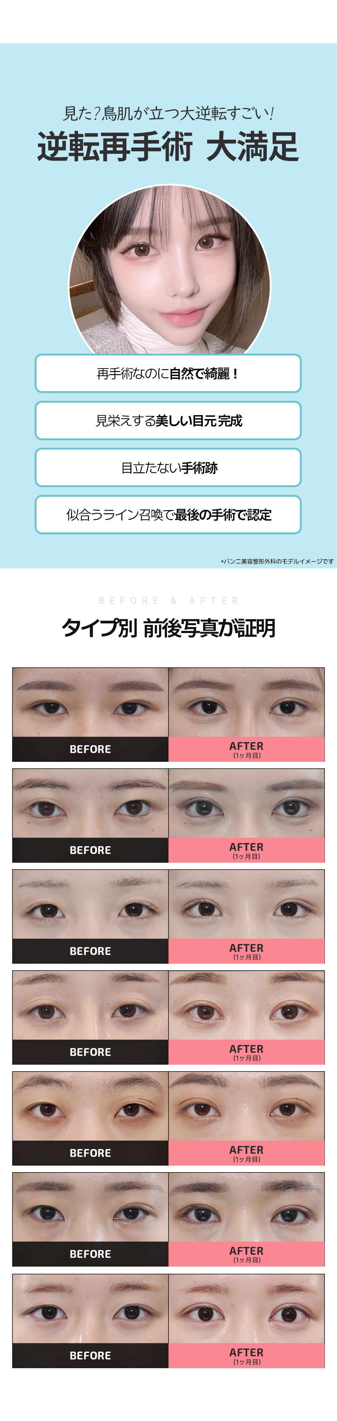 Hướng đến kết quả tự nhiên với phẫu thuật lại mắt｜Banni Thẩm mỹ Gangnam Hàn Quốc｜650.000 won (khoảng 70.000 yên)