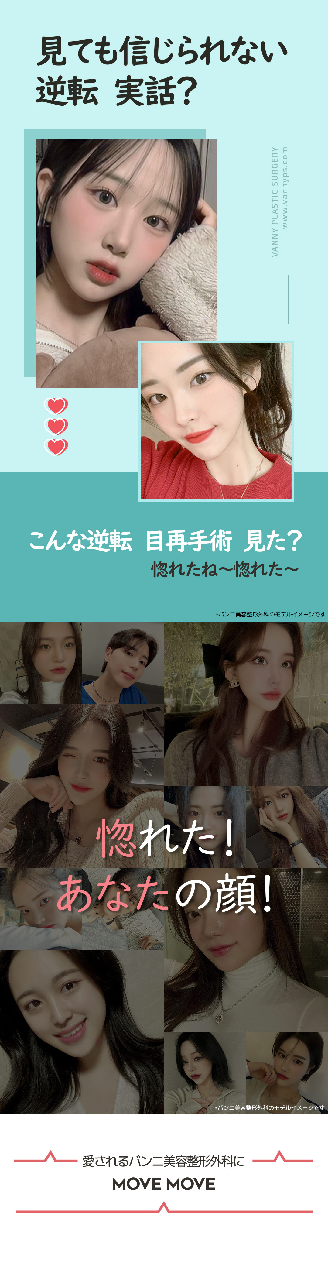 Hướng đến kết quả tự nhiên với phẫu thuật lại mắt｜Banni Thẩm mỹ Gangnam Hàn Quốc｜650.000 won (khoảng 70.000 yên)