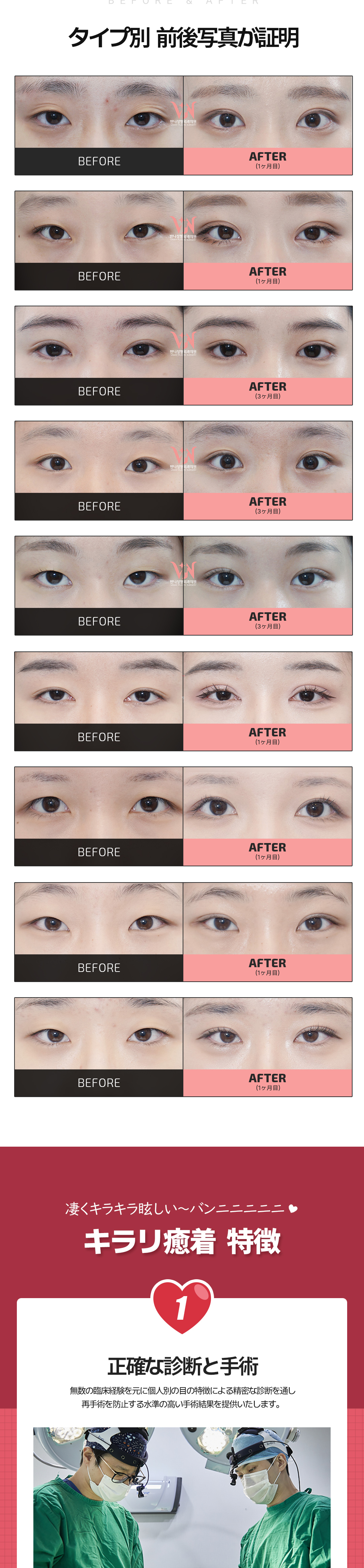 Hướng tới đôi mắt tự nhiên với Phương pháp dính Kirari mí đôi | Bấm mí khó tuột và sẹo khó thấy | Banni Thẩm mỹ・Cách ga Gangnam 1 phút đi bộ