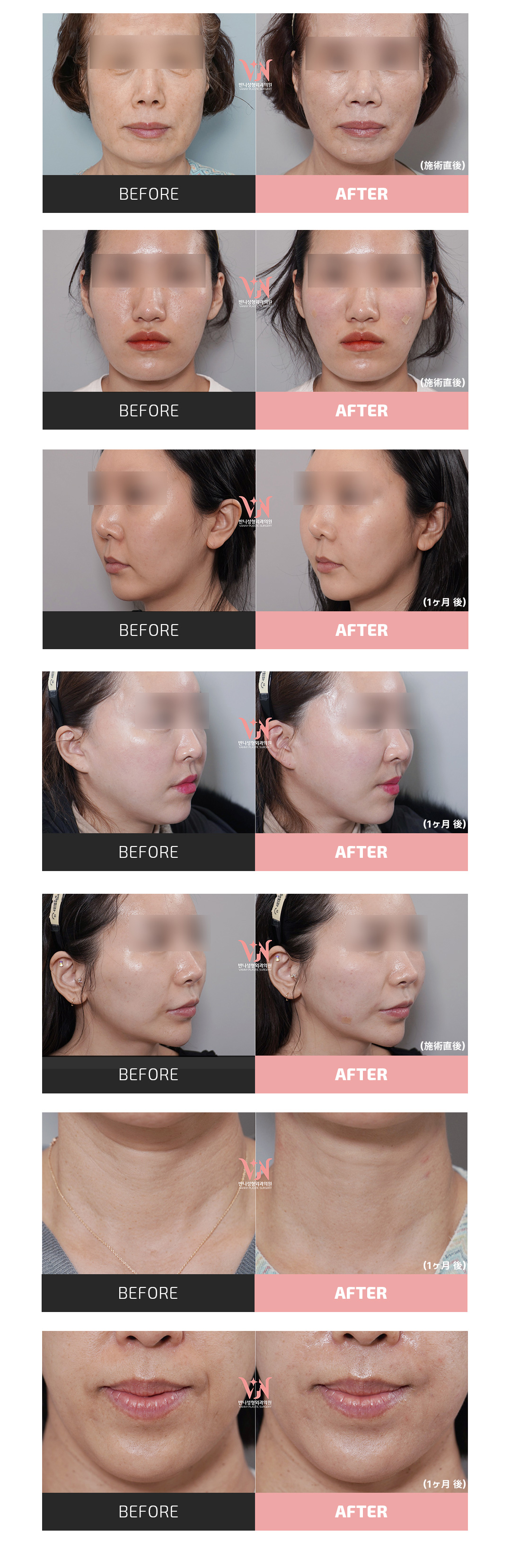 Banni Juvelook & Juvelook Volume