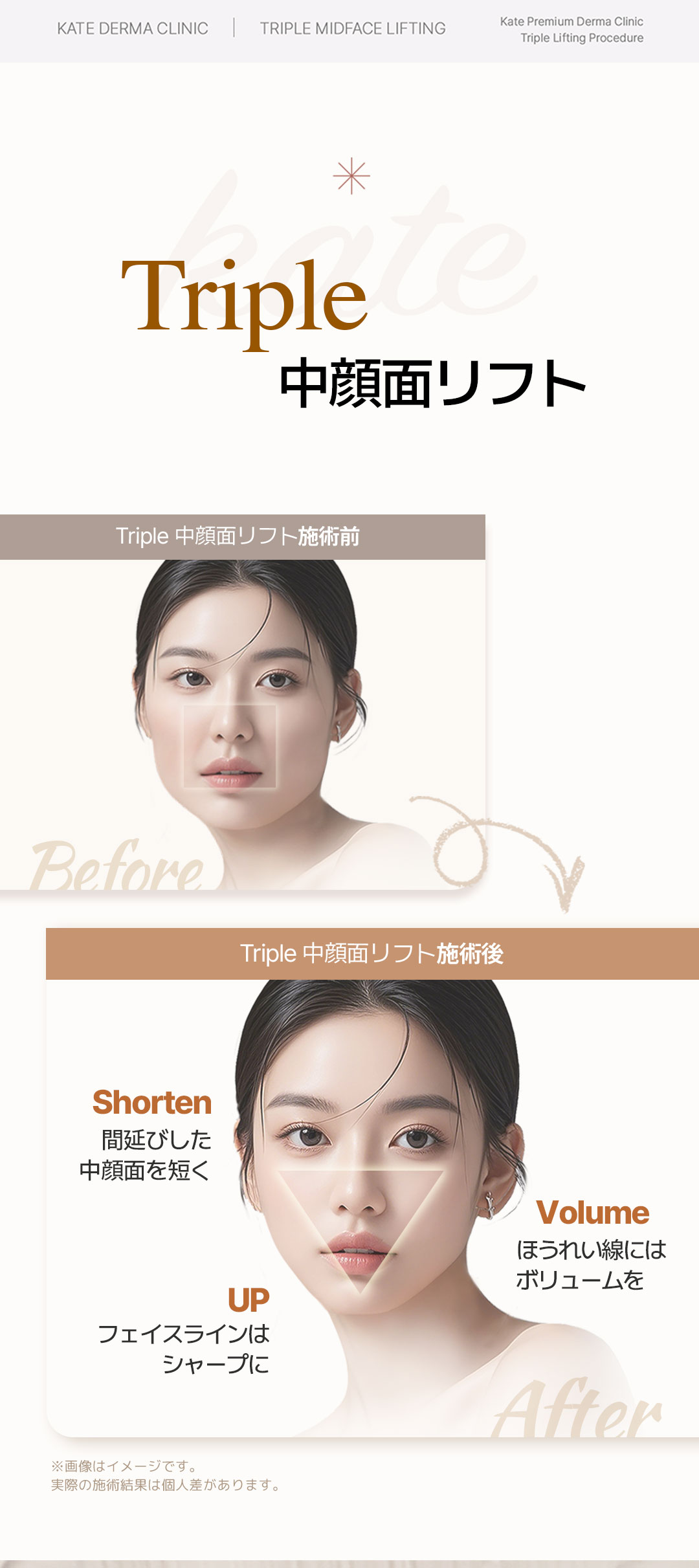 Triple Mid-Face Lift | Thủ thuật kết hợp chỉ nâng + filler nhằm ấn tượng trẻ trung lập thể | Kate Clinic Hongdae, Seoul