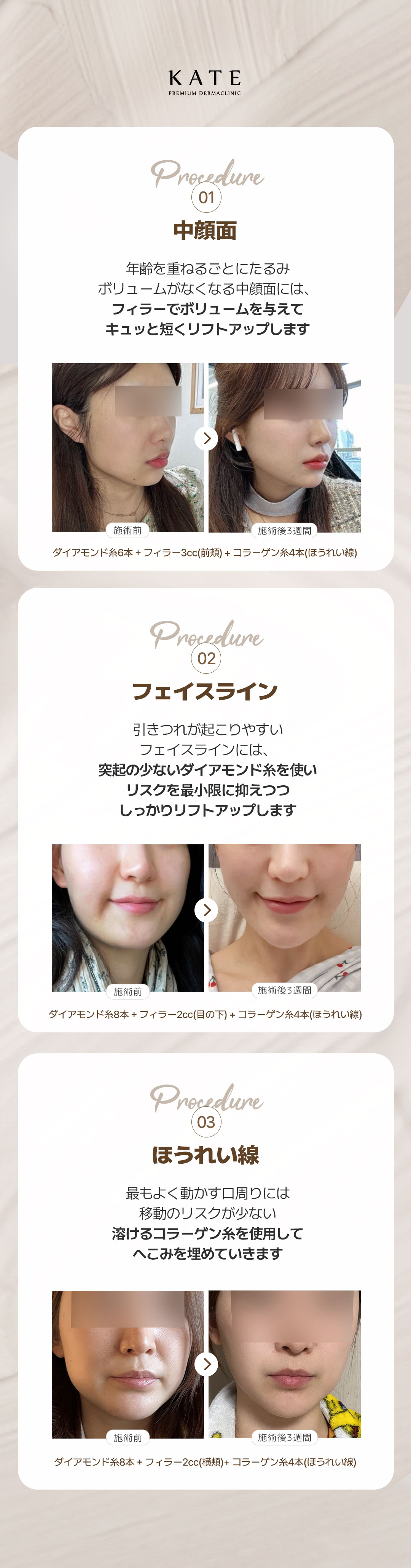 Triple Mid-Face Lift | Thủ thuật kết hợp chỉ nâng + filler nhằm ấn tượng trẻ trung lập thể | Kate Clinic Hongdae, Seoul