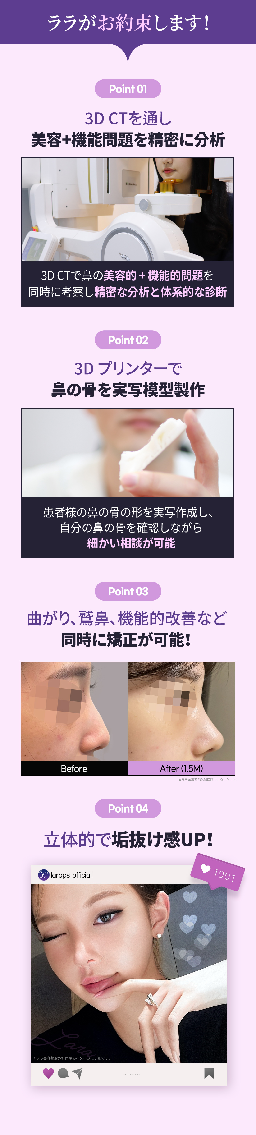 Gangnam Seoul Hàn Quốc | Tạo sống mũi tự nhiên với Nâng mũi in 3D | Phòng khám Lala Thẩm mỹ