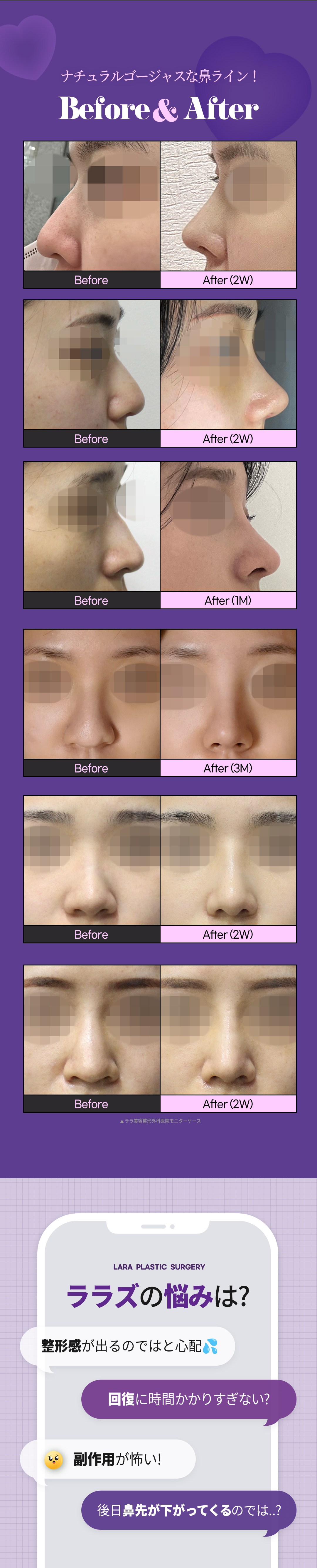 Gangnam Seoul Hàn Quốc | Tạo sống mũi tự nhiên với Nâng mũi in 3D | Phòng khám Lala Thẩm mỹ