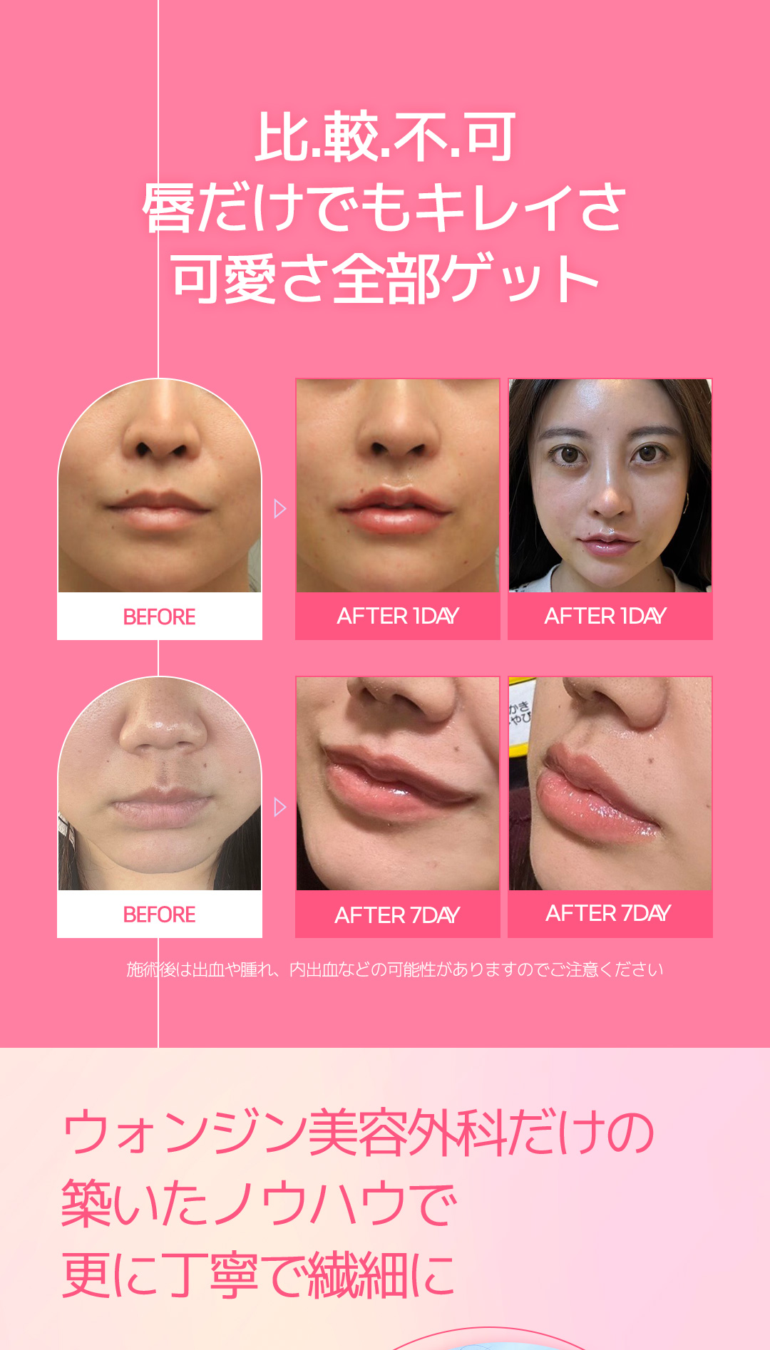 Bộ filler môi chữ M + Botox khóe miệng｜Thủ thuật hướng đến môi đáng yêu｜Phẫu thuật Thẩm mỹ WJ Wonjin ga Gangnam 3 phút