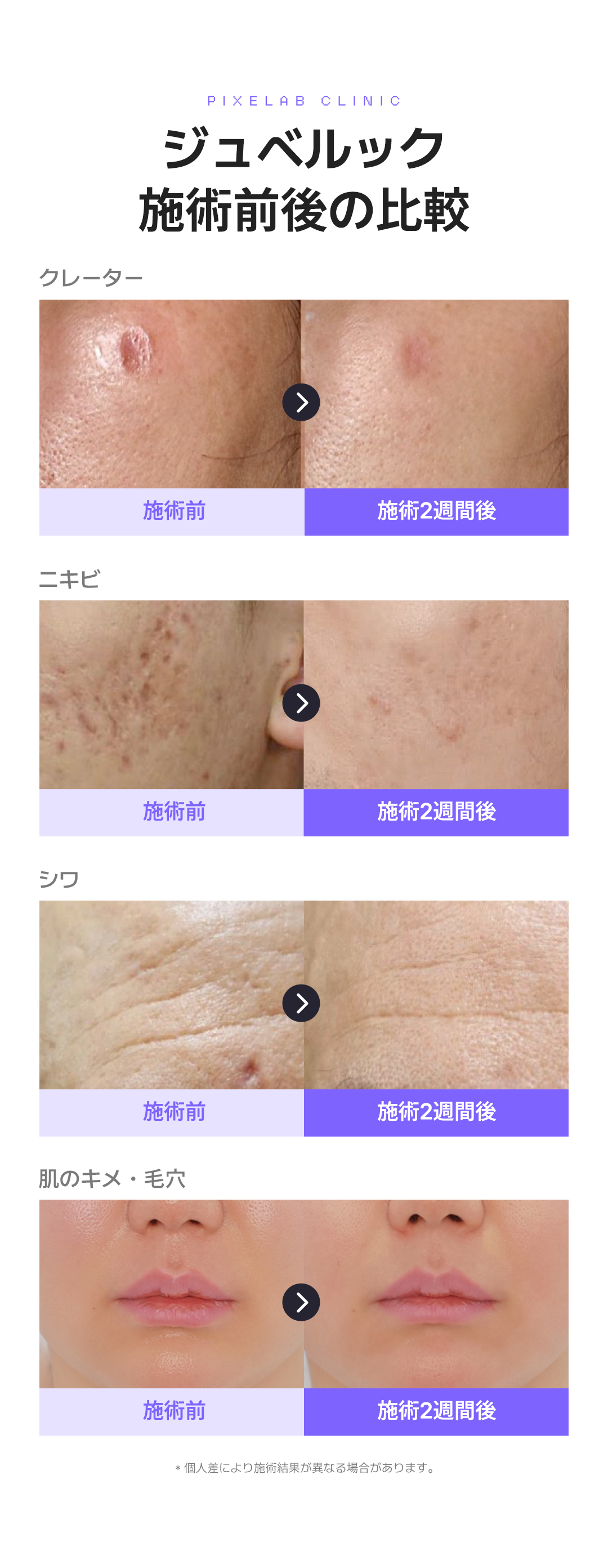 Điều trị Juvelook | Cải thiện độ đàn hồi và kết cấu da bằng thúc đẩy sản sinh collagen | Phòng khám Phẫu thuật Thẩm mỹ Pixel Lab Gangnam