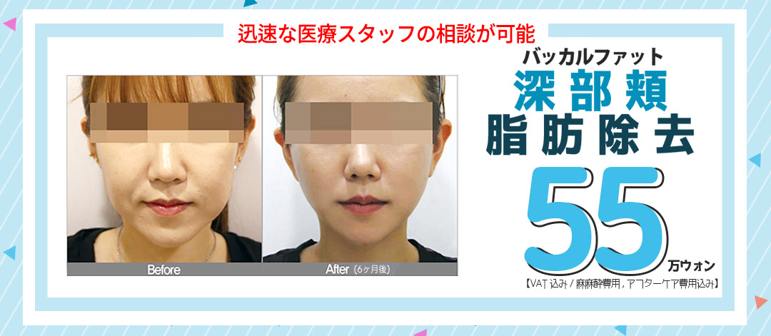 Loại bỏ mỡ Buccal (mỡ má sâu) tạo mặt nhỏ | Hơn 30 năm kinh nghiệm | Thẩm mỹ viện Jerim ngay ga Apgujeong