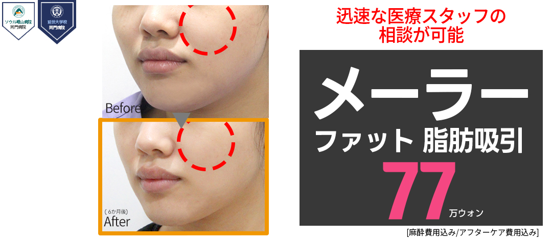 Hút mỡ Malar Fat tạo đường viền mặt trẻ | Thẩm mỹ viện Jerim Seoul Apgujeong | Điều trị 30 phút