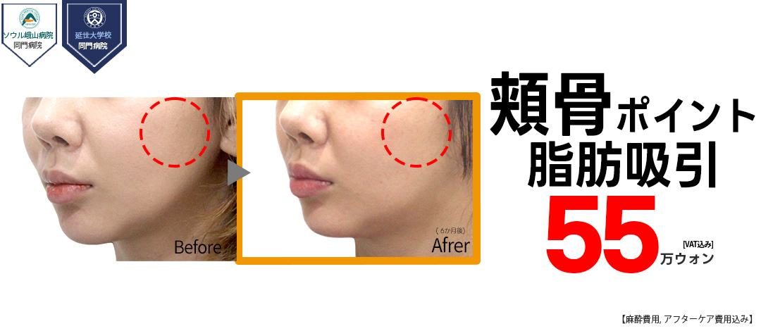 Hút mỡ điểm xương gò má hướng đến mặt nhỏ | Loại bỏ mỡ 3 lớp | Jerim Thẩm mỹ Ngoại khoa | Cách ga Apgujeong 1 phút