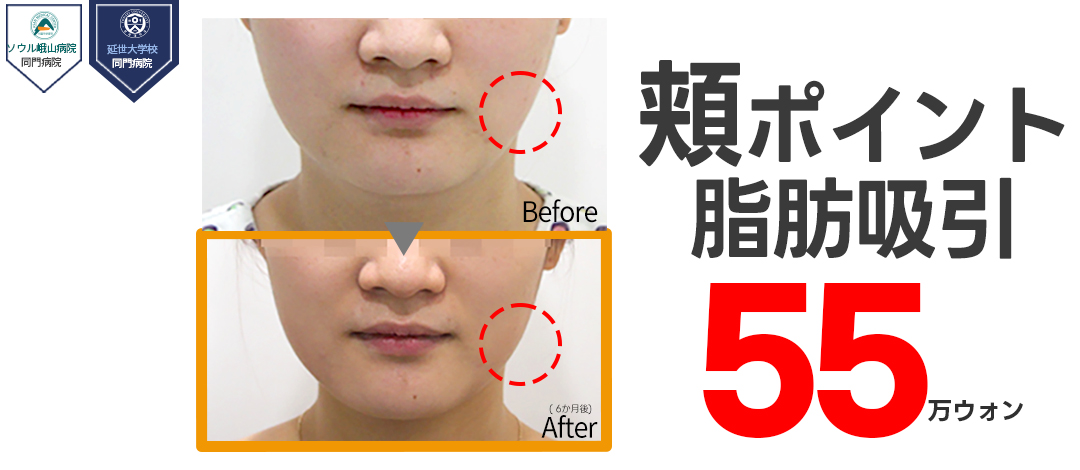 Hút mỡ má Hàn Quốc hướng đến mặt nhỏ | Loại bỏ mỡ 3 lớp chính xác bởi cơ sở y tế liên kết Đại học Yonsei Jerim Thẩm mỹ Ngoại khoa