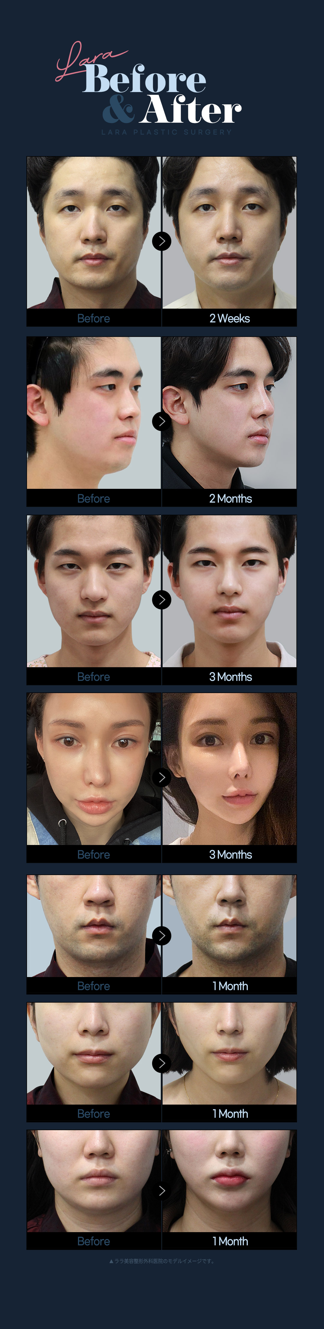 Hút mỡ mặt tạo V-line tự nhiên | Điều trị tinh tế bằng phương pháp thủ công | LaLa Gangnam Seoul