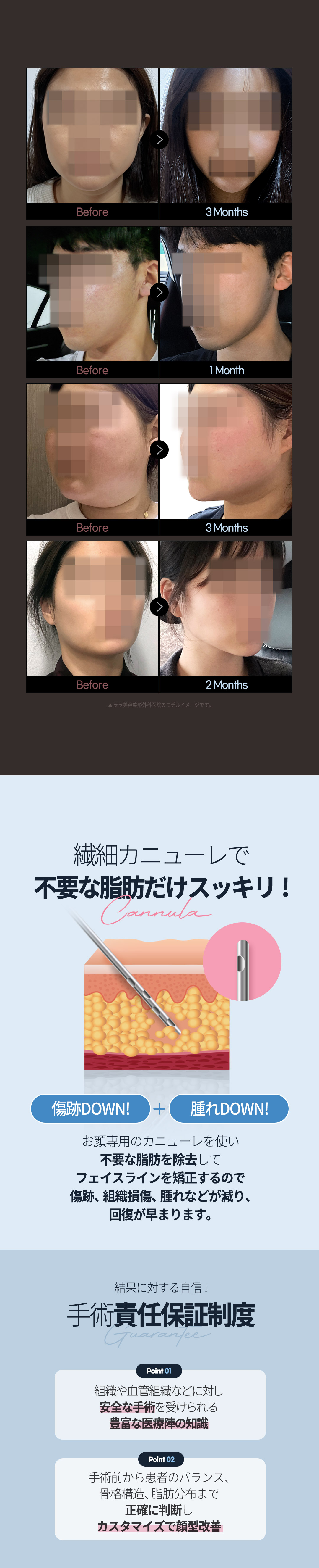 Hút mỡ mặt tạo V-line tự nhiên | Điều trị tinh tế bằng phương pháp thủ công | LaLa Gangnam Seoul