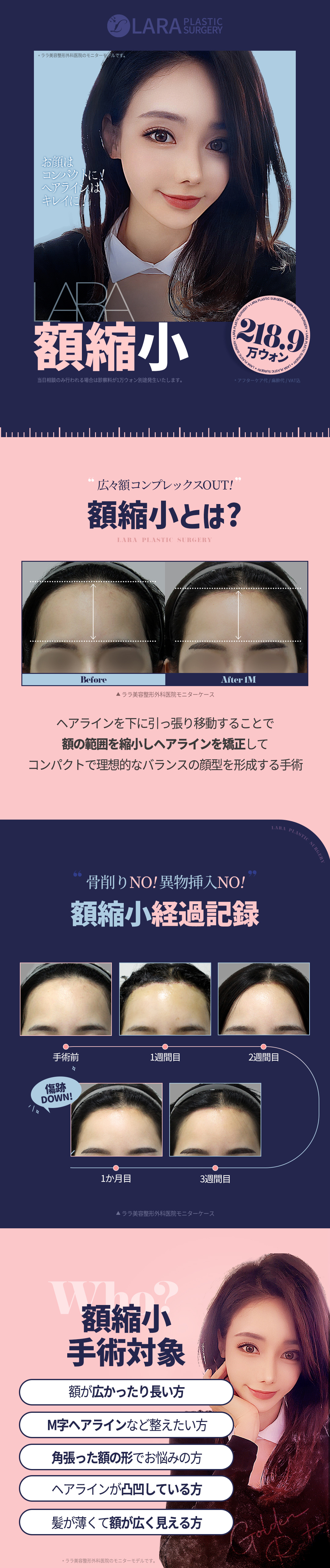 Hướng đến cân đối khuôn mặt lý tưởng với phẫu thuật thu nhỏ trán｜Lala Thẩm mỹ Phẫu thuật Tạo hình không gọt xương・bảo vệ chân tóc