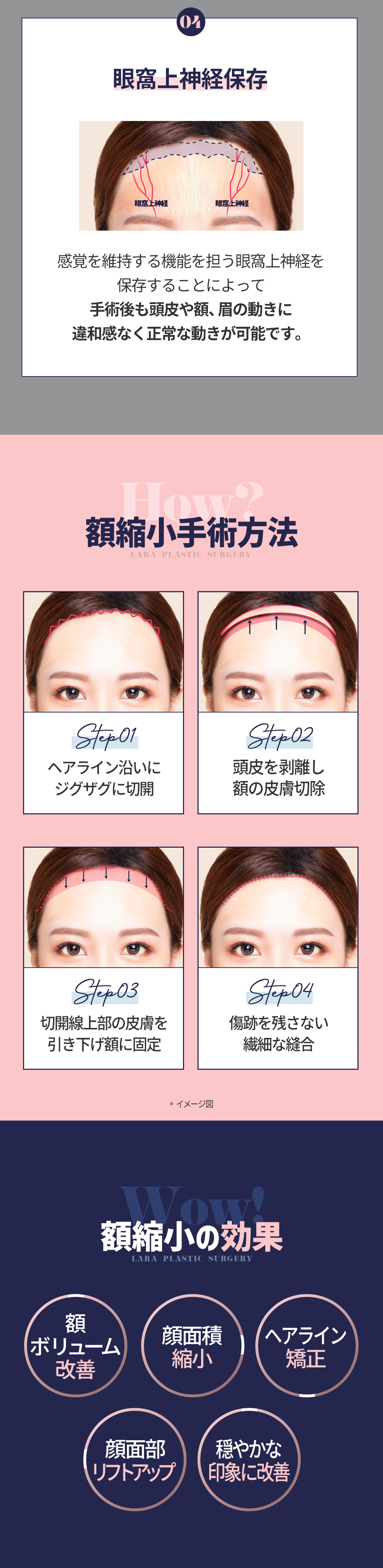 Hướng đến cân đối khuôn mặt lý tưởng với phẫu thuật thu nhỏ trán｜Lala Thẩm mỹ Phẫu thuật Tạo hình không gọt xương・bảo vệ chân tóc