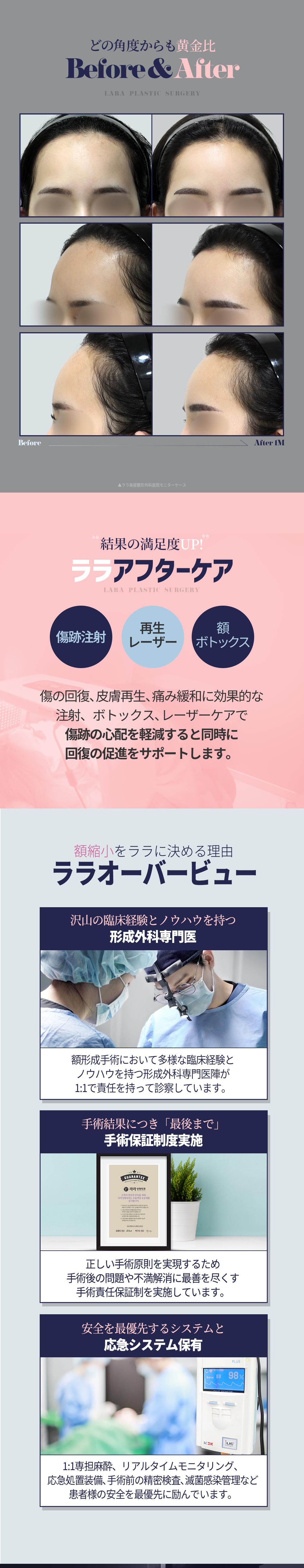 Hướng đến cân đối khuôn mặt lý tưởng với phẫu thuật thu nhỏ trán｜Lala Thẩm mỹ Phẫu thuật Tạo hình không gọt xương・bảo vệ chân tóc