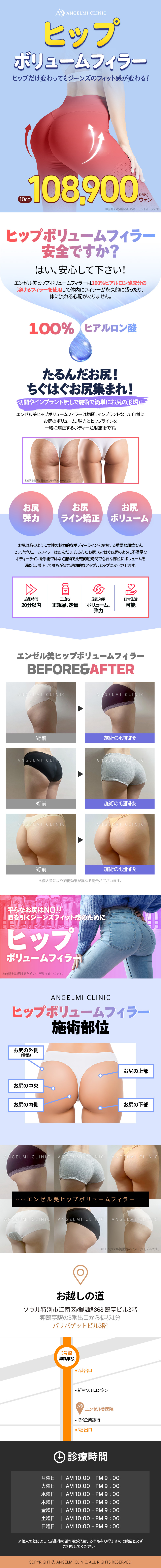 Filler tăng độ căng mông｜Tiêm Hyaluronic Acid không cần rạch hướng đến nâng mông｜Phòng khám Angel Mi Apgujeong