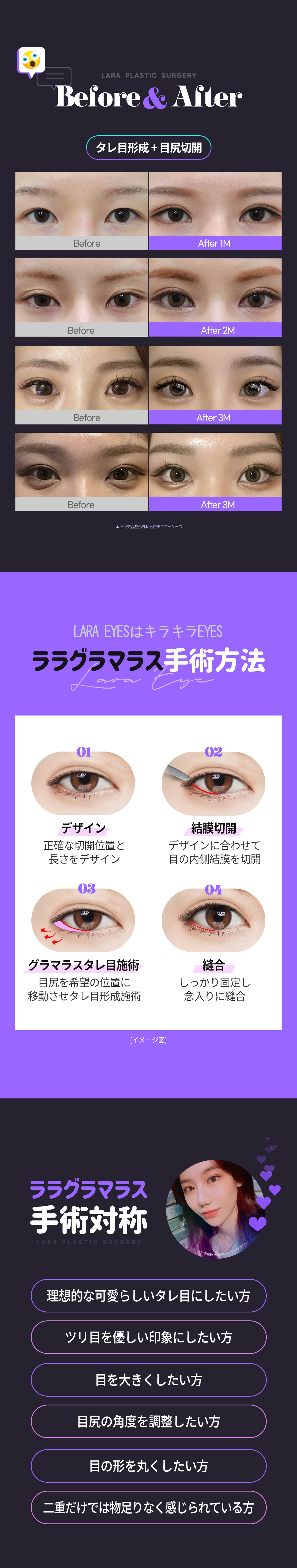 Hướng tới cải thiện mắt tự nhiên với Tạo mắt cụp Glamorous | Seoul Gangnam stn.・Lala Thẩm mỹ Phòng khám【Thẩm mỹ Hàn Quốc】