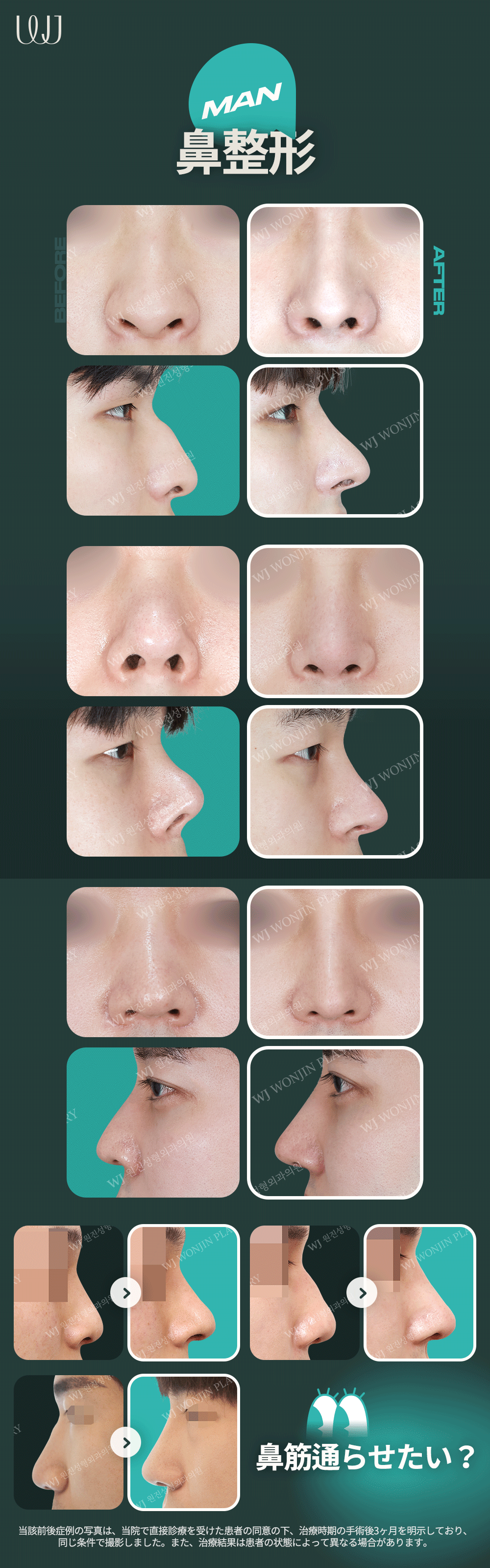 【Nâng mũi nam giới】Nâng mũi Hàn Quốc hướng tới kết hợp chức năng và vẻ đẹp | WJ Wonjin Phẫu thuật Thẩm mỹ Gangnam