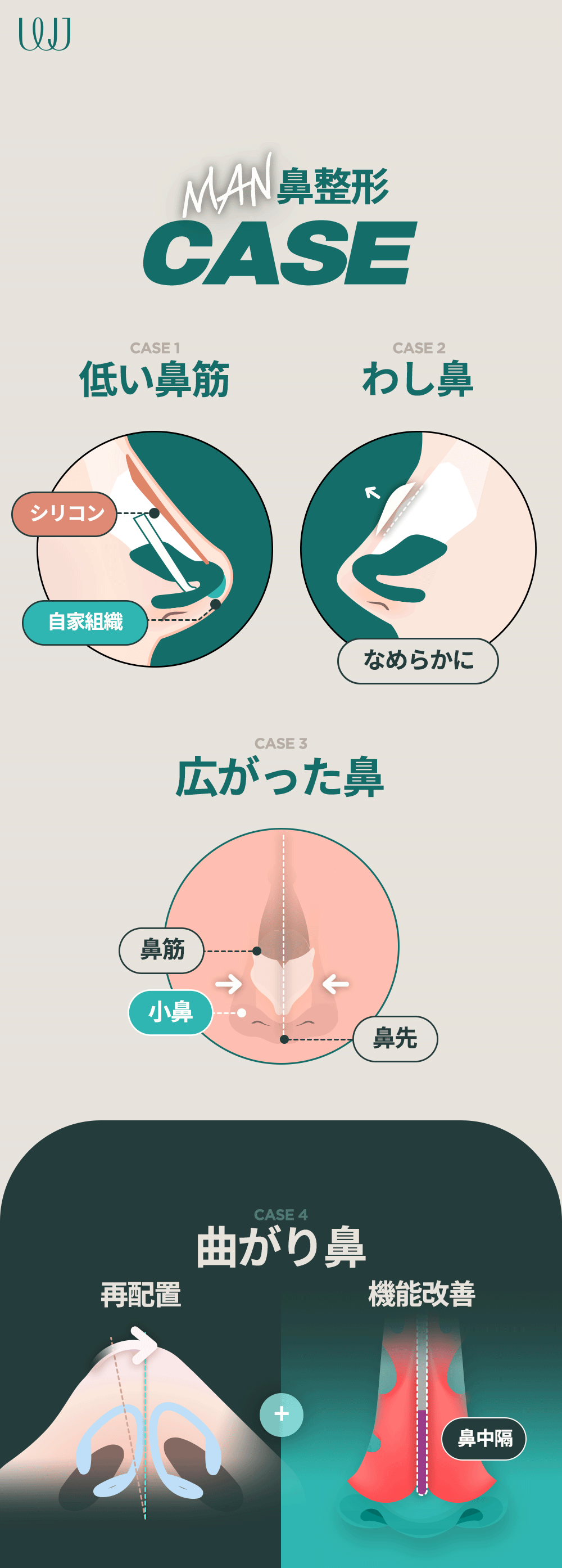 【Nâng mũi nam giới】Nâng mũi Hàn Quốc hướng tới kết hợp chức năng và vẻ đẹp | WJ Wonjin Phẫu thuật Thẩm mỹ Gangnam