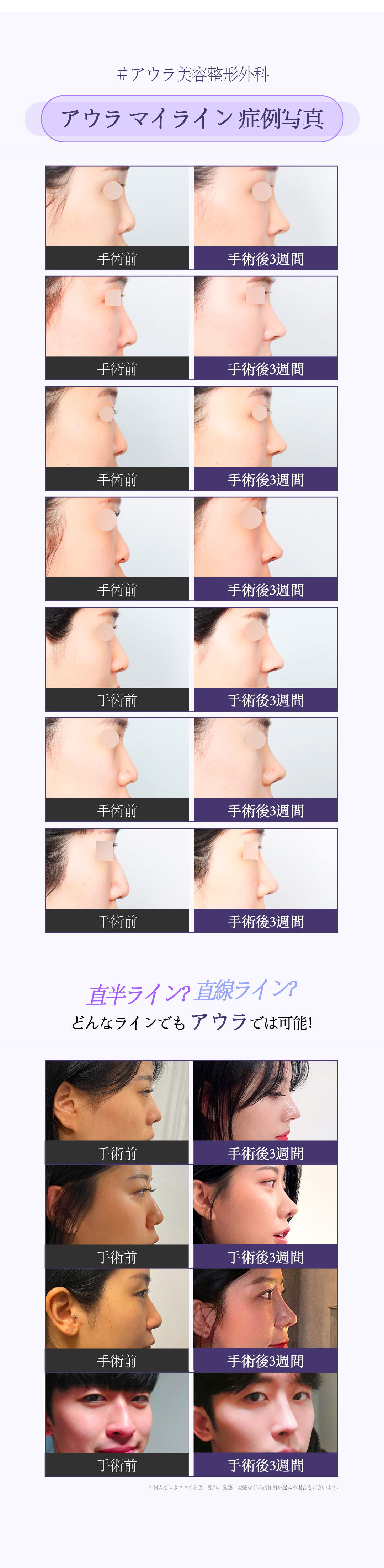 【Ga Gangnam】Phẫu thuật mũi Aura Thẩm mỹ | Hướng tới đầu mũi lý tưởng với chẩn đoán chính xác 3D CT × Thiết kế đường nét cá nhân