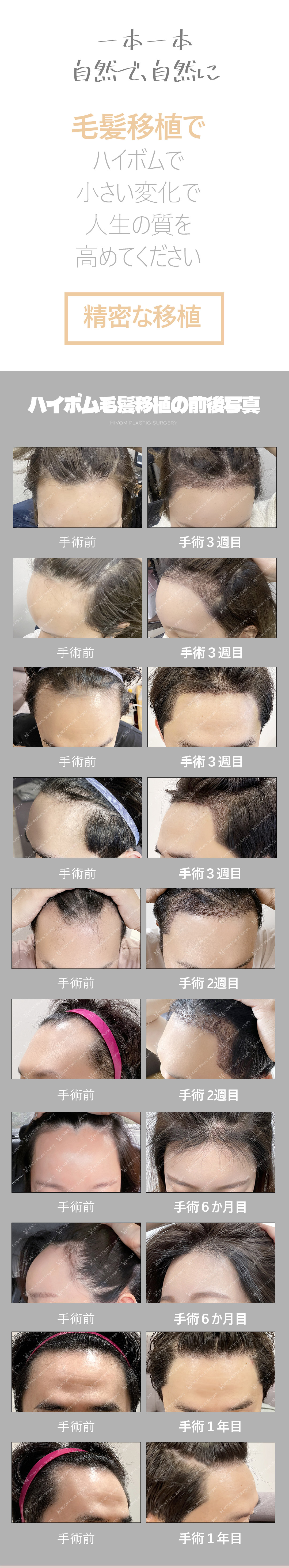 Cấy tóc Hàn Quốc 1000 nang | Giới hạn 1 người/ngày, điều trị tận tình bởi bác sĩ chuyên khoa | Hi-Beom Clinic Gangnam Seoul