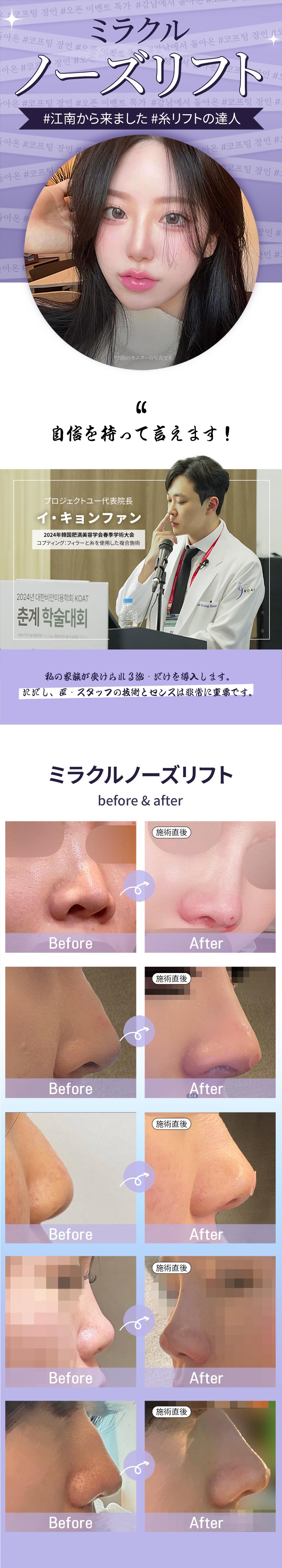 Miracle Nose Lift | Chỉnh mũi không cắt để có sống mũi và đầu mũi tự nhiên | Phòng khám Project You Hongdae