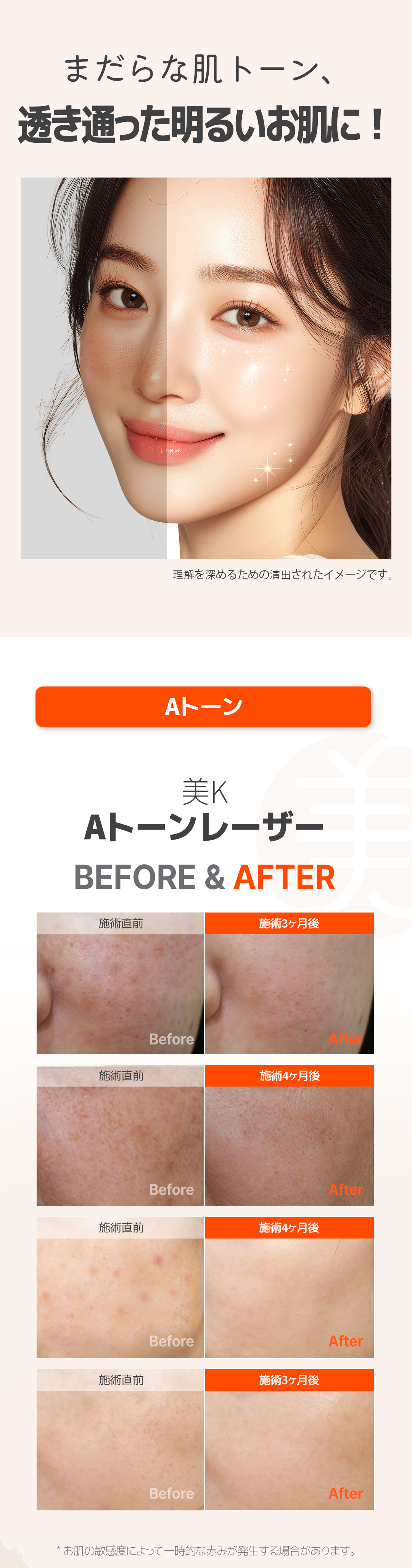 Laser Toning & Fraxel tại Phòng khám Mi K gần ga Gangnam | Cải thiện đốm nám, xỉn màu và lỗ chân lông