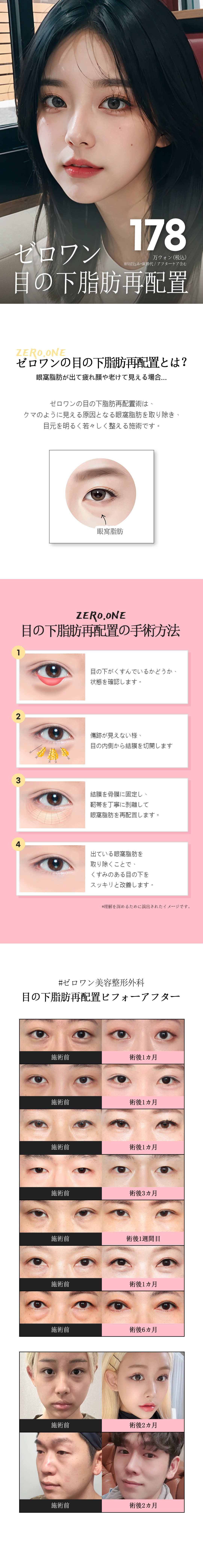 Tái định vị mỡ dưới mắt cho đôi mắt trẻ trung | Điều trị bởi bác sĩ chuyên khoa tạo hình Hàn Quốc | Zero One Plastic Surgery ga Gangnam