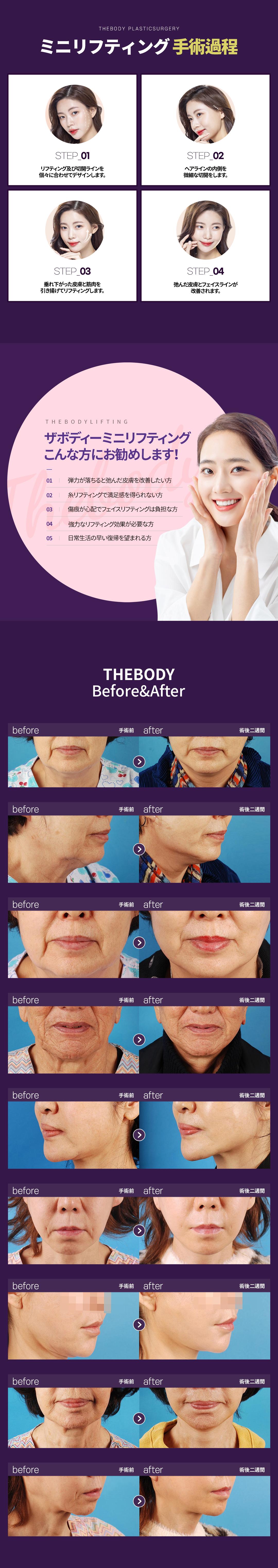 Phẫu thuật Mini Lifting Busan｜Nhắm đến nâng tự nhiên với rạch tối thiểu｜Phòng khám Thẩm mỹ Ngoại khoa The Body