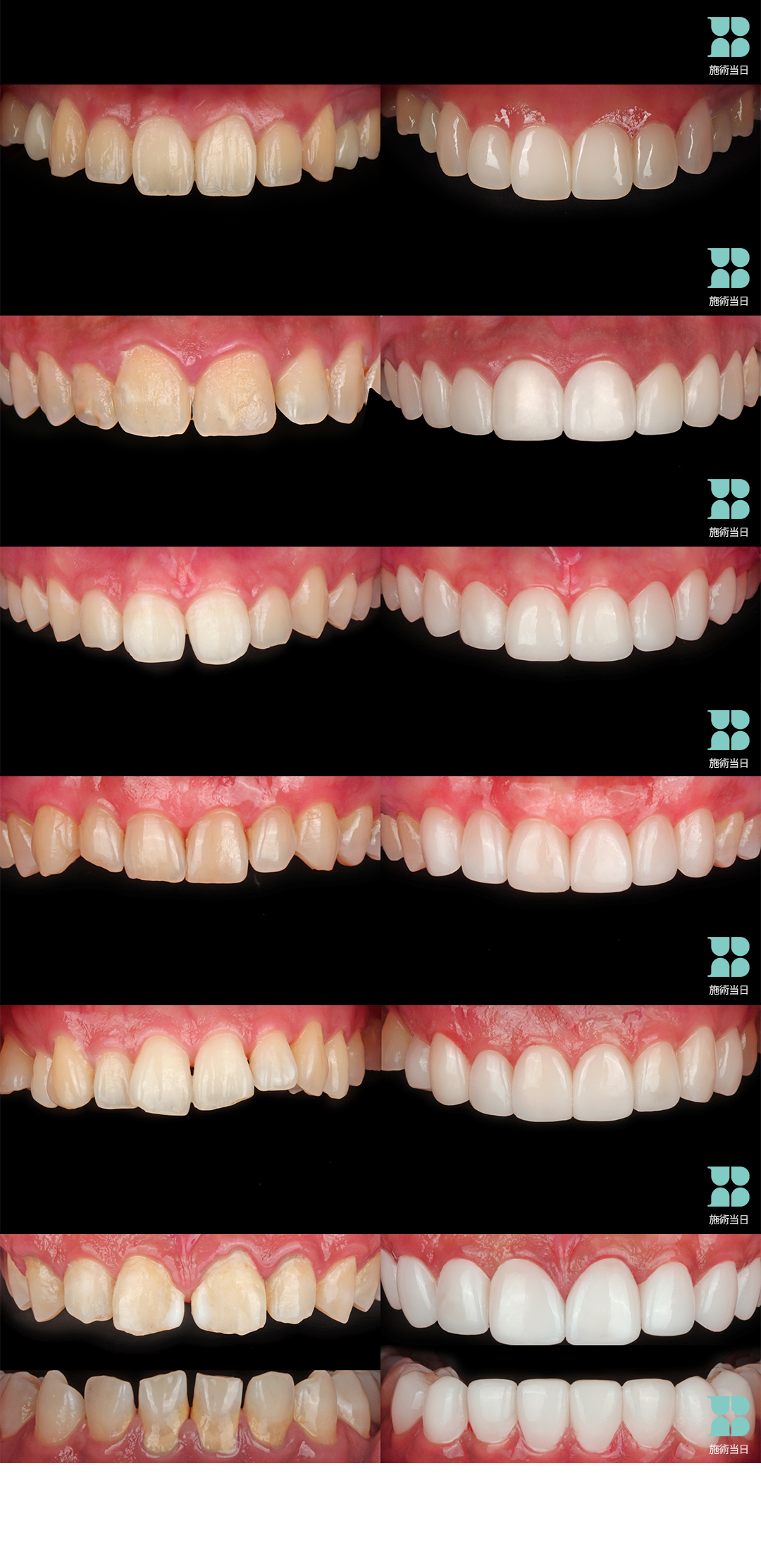 Laminate không mài | Blanche Dental | Hướng tới răng trắng tự nhiên với Veneer siêu mỏng 0,01mm | Seoul Gangnam